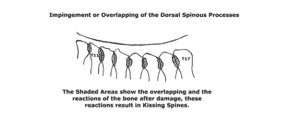 kissing spines treatments thoracic